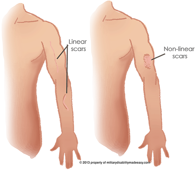 Scar Tissue Explained - NAVINA